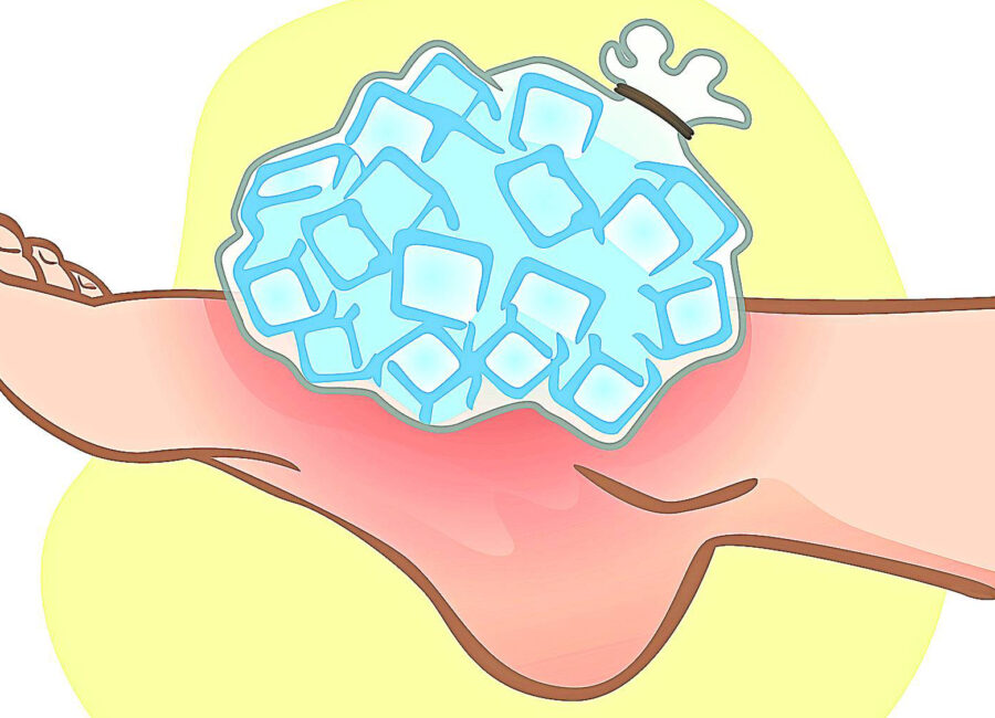 con lesion durante el ciclismo es mejor aplicar frio o calor para recuperarse