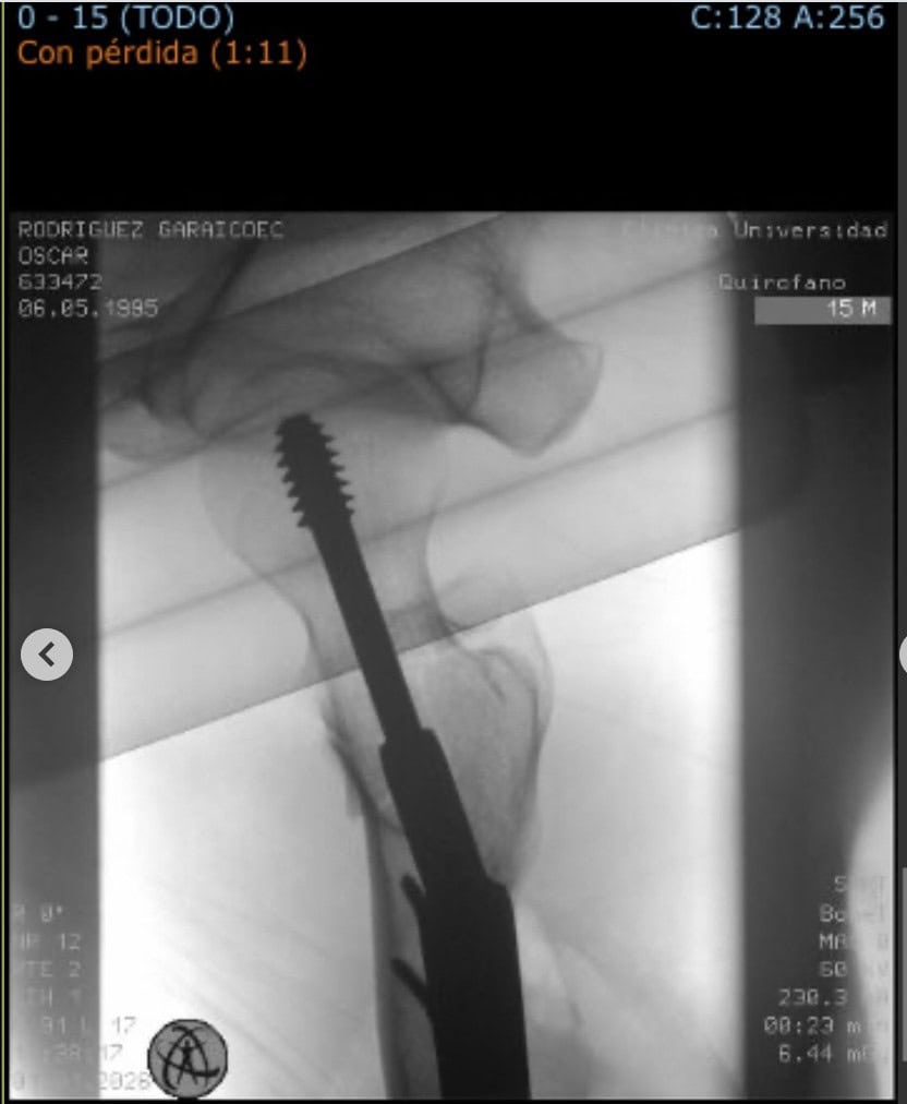 Óscar Rodríguez sufre una fractura de cadera entrenando